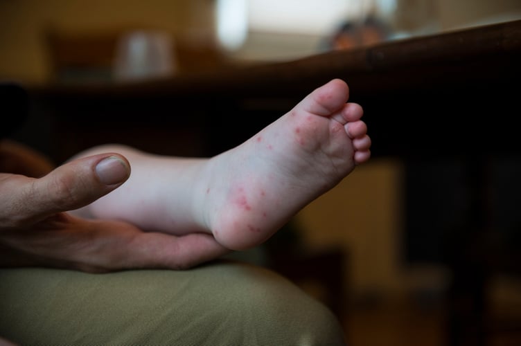 Foot and mouth disease is 'circulating in the Isle of Man' at present